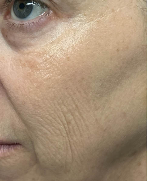 1_0001_patient 8 after CO2 laser- left side.png