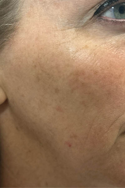 1_0002_patient 12 before ultraclear with laser coring- right side.png