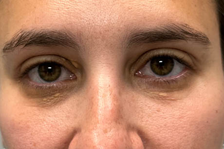 1_0002_patient 15 before xanthelasma excision- open.png