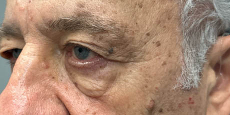 1_0002_patient 19 before upper bleph with direct browlift- left side.png