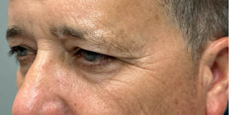 1_0002_patient 21 before quad bleph with CO2, facial fat grafting and direct brow lift- left side.png