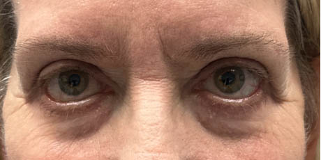 1_0002_patient 5 before lower bleph revision with hard palate grafts, mid face lift and canthoplasty- front.png