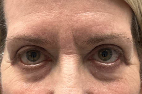 1_0002_patient 5 before lower bleph revision with hard palate grafts, mid face lift and canthoplasty- front.png