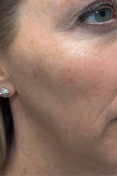 1_0003_patient 12 after ultraclear with laser coring- right side.png