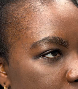 1_0003_patient 15 after removal of brow cyst -side.png