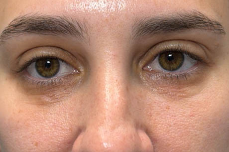 1_0003_patient 15 after xanthelasma excision- open.png