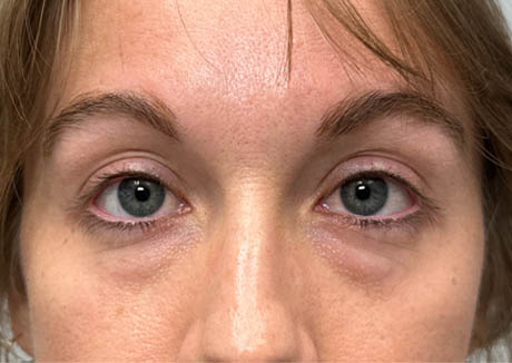 1_0003_patient 15 before lower bleph with fat grafting and CO2.png