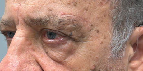 1_0003_patient 19 after upper bleph with direct browlift- left side.png
