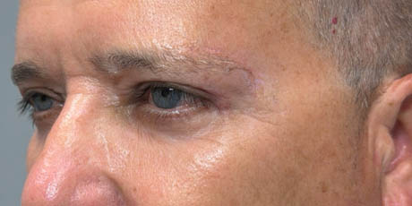 1_0003_patient 21 after quad bleph with CO2, facial fat grafting and direct brow lift- left side.png