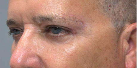 1_0003_patient 21 after quad bleph with CO2, facial fat grafting and direct brow lift- left side.png