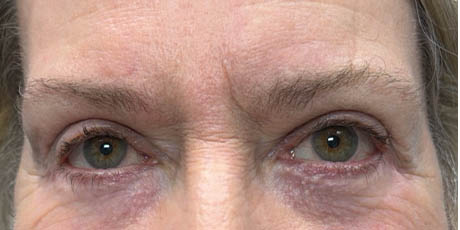 1_0003_patient 5 after lower bleph revision with hard palate grafts, mid face lift and canthoplasty- front.png