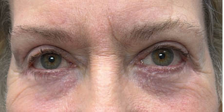 1_0003_patient 5 after lower bleph revision with hard palate grafts, mid face lift and canthoplasty- front.png