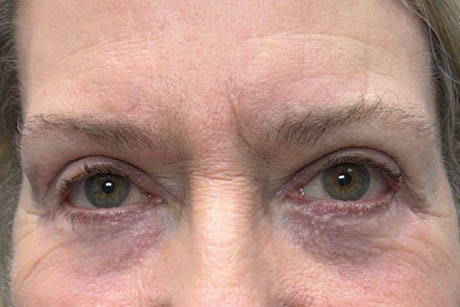 1_0003_patient 5 after lower bleph revision with hard palate grafts, mid face lift and canthoplasty- front.png