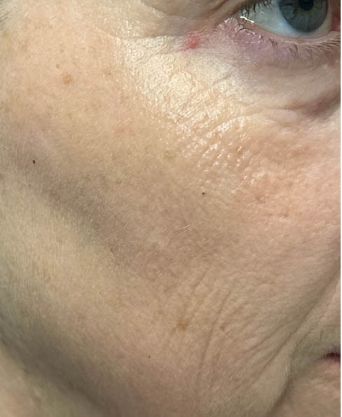 1_0003_patient 8 after CO2 laser- right side.png