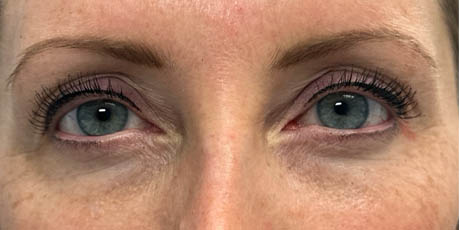 1_0004_patient 12 before ultraclear with laser coring.png