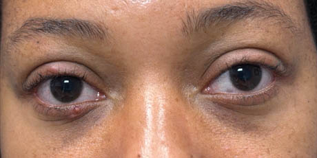 1_0004_patient 14 before chalazia removal- front.png