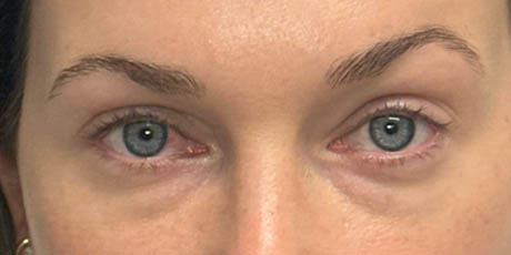 1_0004_patient 14 before lower bleph with facial fat grafting and CO2 laser.png