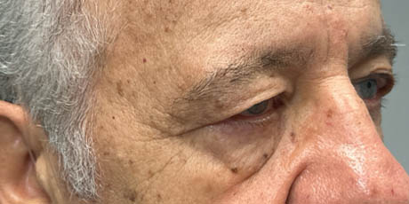 1_0004_patient 19 before upper bleph with direct browlift- right side.png