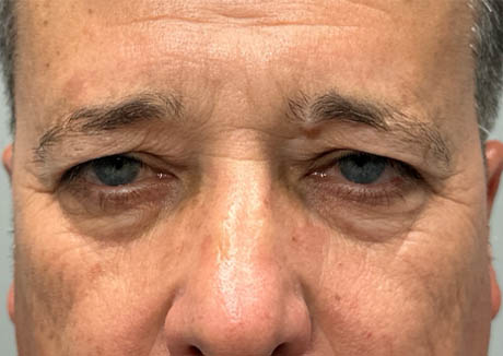 1_0004_patient 21 before quad bleph with CO2, facial fat grafting and direct brow lift- front.png