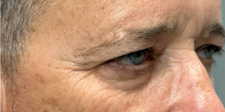 1_0004_patient 21 before quad bleph with CO2, facial fat grafting and direct brow lift- right side – Copy.png