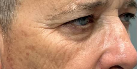1_0004_patient 21 before quad bleph with CO2, facial fat grafting and direct brow lift- right side – Copy.png