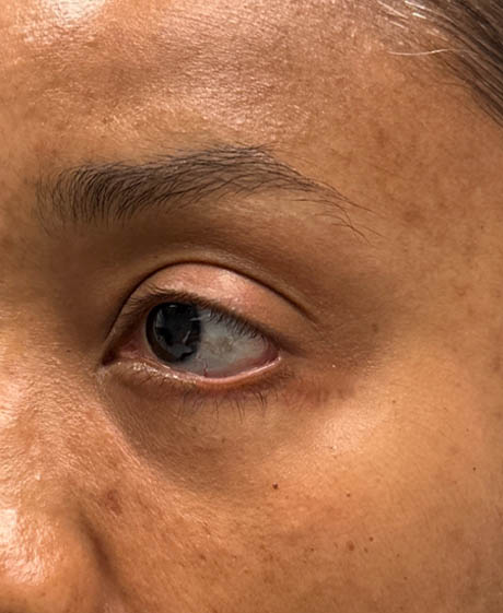 1_0004_patient 4 before lower bleph revision with hard palate grafts, mid face lift and canthoplasty- side.png