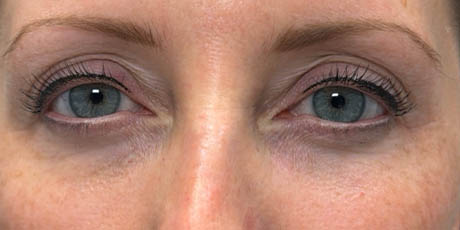 1_0005_patient 12 after ultraclear with laser coring.png