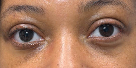 1_0005_patient 14 after chalazia removal- front.png