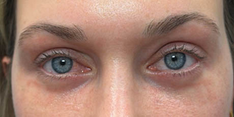 1_0005_patient 14 after lower bleph with facial fat grafting and CO2 laser.png