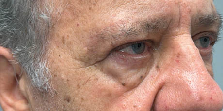 1_0005_patient 19 after upper bleph with direct browlift- right side.png