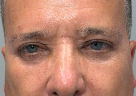 1_0005_patient 21 after quad bleph with CO2, facial fat grafting and direct brow lift- front.png