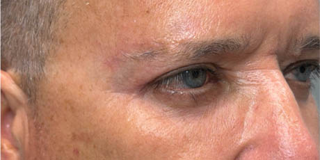 1_0005_patient 21 after quad bleph with CO2, facial fat grafting and direct brow lift- right side.png