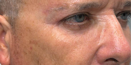1_0005_patient 21 after quad bleph with CO2, facial fat grafting and direct brow lift- right side.png