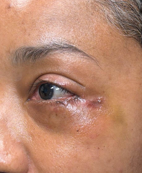 1_0005_patient 4 after lower bleph revision with hard palate grafts, mid face lift and canthoplasty- side.png