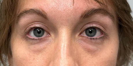 1_0006_patient 15 before lower bleph with fat grafting and CO2.png