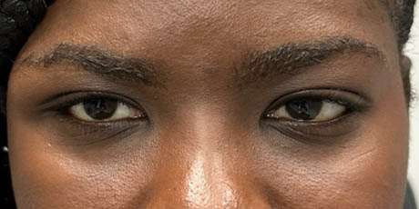 1_0006_patient 15 before removal of brow cyst- front.png