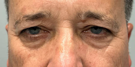 1_0006_patient 21 before quad bleph with CO2, facial fat grafting and direct brow lift- front.png