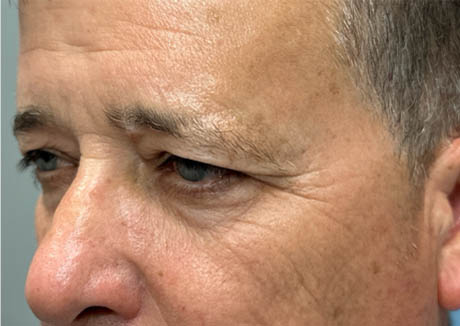 1_0006_patient 21 before quad bleph with CO2, facial fat grafting and direct brow lift- left side.png