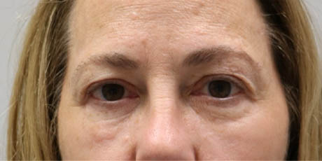 1_0006_patient 22 before quad bleph with facial fat grafting and CO2 laser- front.png