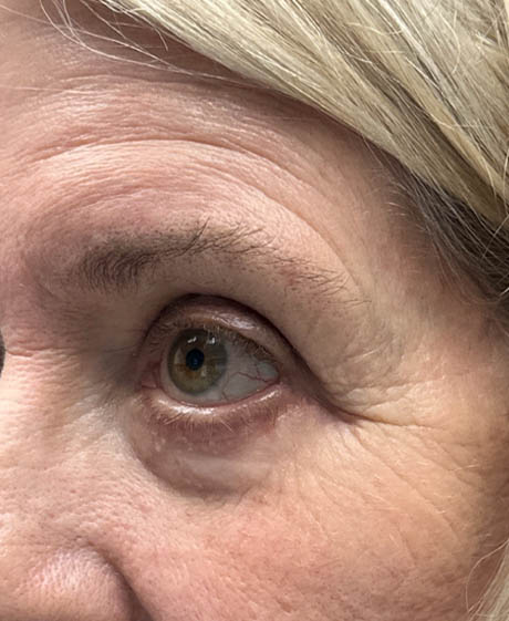 1_0006_patient 5 before lower bleph revision with hard palate grafts, mid face lift and canthoplasty- side.png