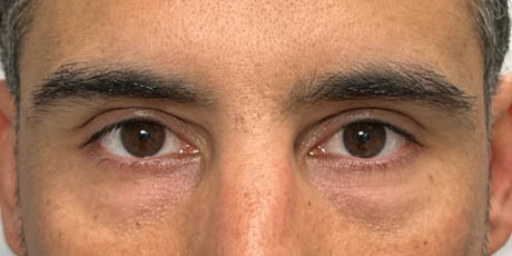 1_0006_patient 61 before lower bleph with facial fat grafting and ultraclear laser- front.png