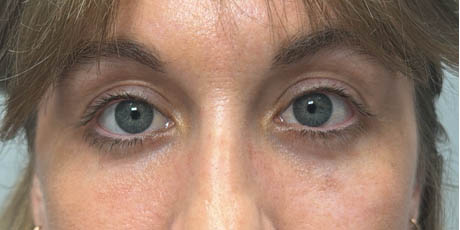 1_0007_patient 15 after lower bleph with fat grafting and CO2.png