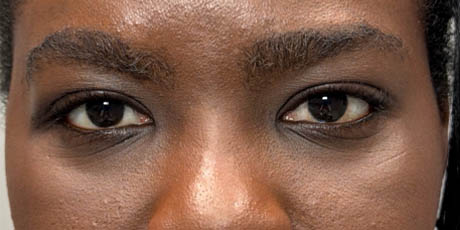1_0007_patient 15 after removal of brow cyst- front.png