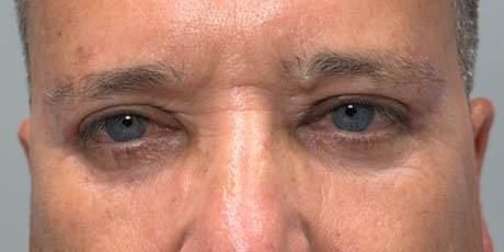 1_0007_patient 21 after quad bleph with CO2, facial fat grafting and direct brow lift- front.png