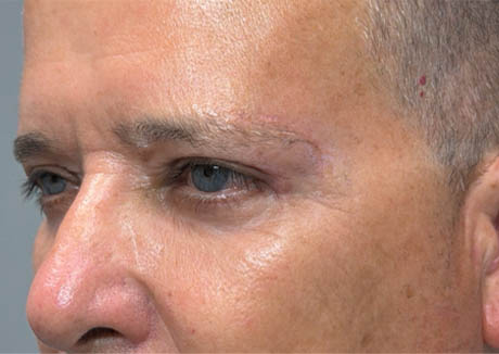 1_0007_patient 21 after quad bleph with CO2, facial fat grafting and direct brow lift- left side.png