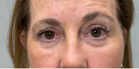 1_0007_patient 22 after quad bleph with facial fat grafting and CO2 laser- front.png