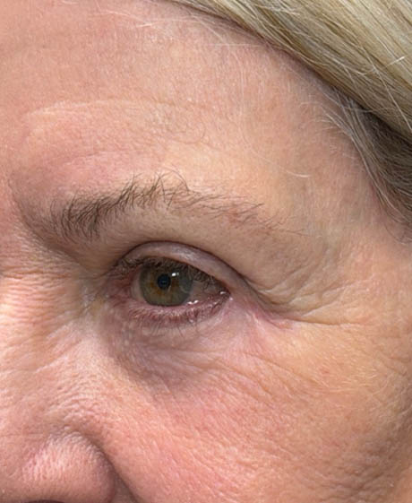 1_0007_patient 5 after lower bleph revision with hard palate grafts, mid face lift and canthoplasty- side.png