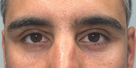 1_0007_patient 61 after lower bleph with facial fat grafting and ultraclear laser- front.png