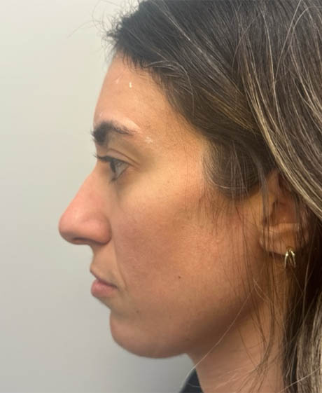 1_0008_patient 17 before chin filler.png