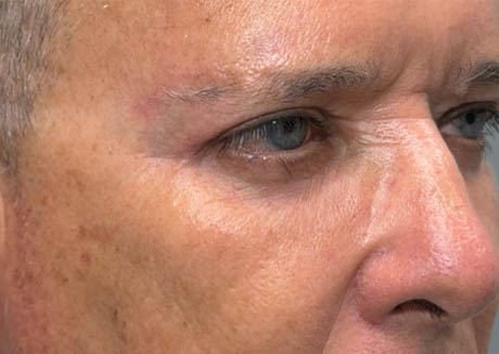 1_0008_patient 21 after quad bleph with CO2, facial fat grafting and direct brow lift- right side.png